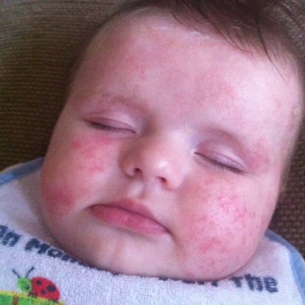 What Does Baby Eczema Look Like