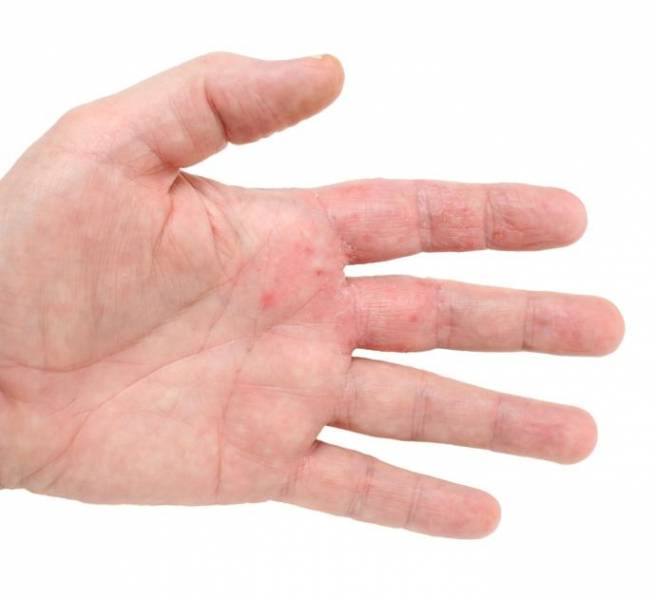 mild eczema on hands