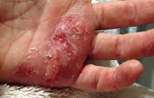 severe-eczema-on-hands