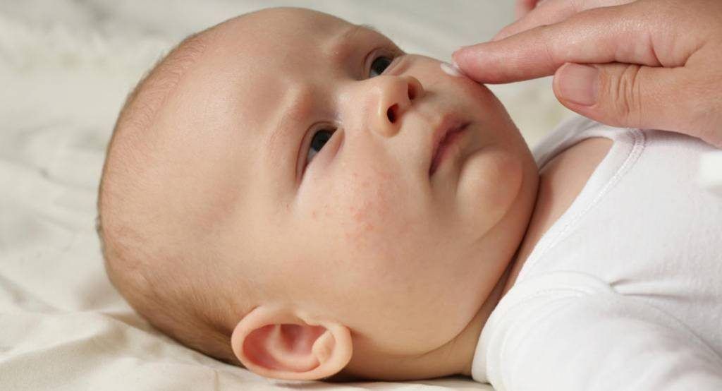 dry skin on face in babies