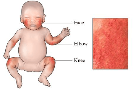 Atopic dermatitis mostly occurs on cheeks, elbow, knee of baby.
