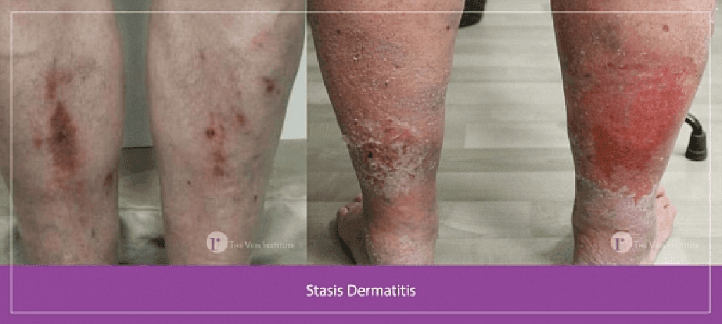Stasis dermatitis